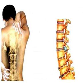 Osteochondrose -Stadien