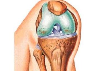 Die Hauptursachen für Knie -Arthrose