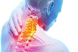 Zervikale Osteochondrose -Symptome und Ernährungsregeln für Krankheiten