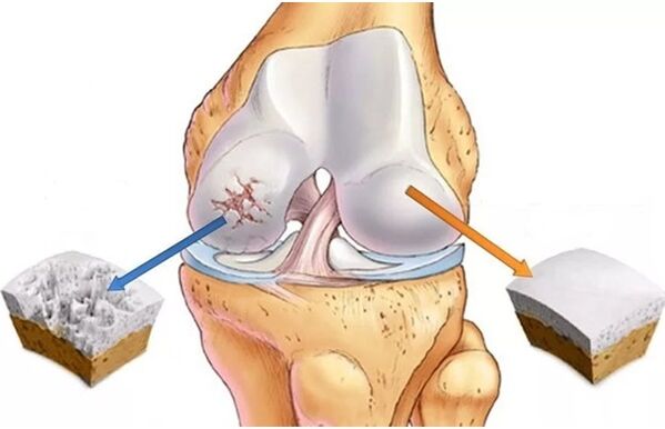 Gesunder Knorpel und Knorpel, der von Arthritis betroffen ist