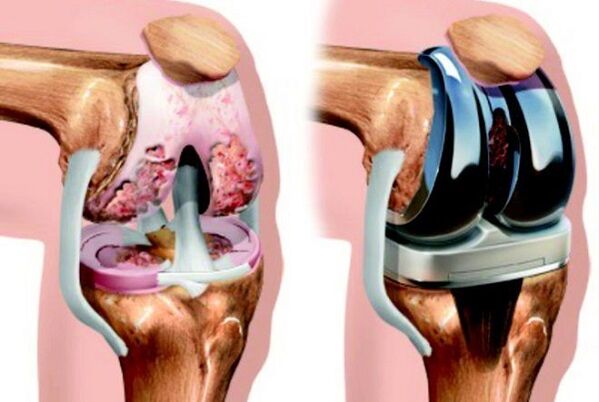 Vor und nach der Endoprotetik des Kniegelenks mit Arthritis