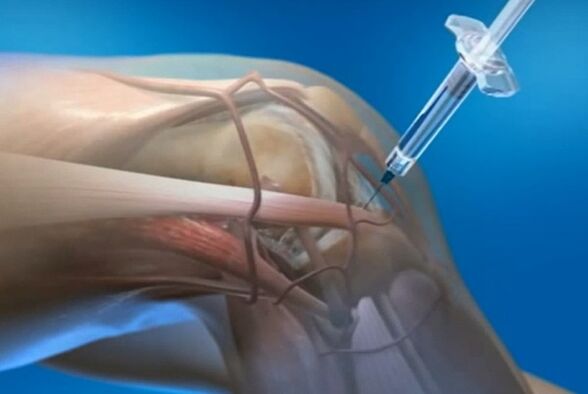 intra -kartikuläre Injektionen für die Arthrose des Kniegelenks