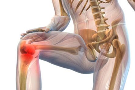 Schmerzen im Kniegelenk bei Arthrose. 