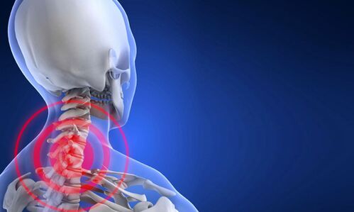 Osteochondrose der Halswirbelsäule