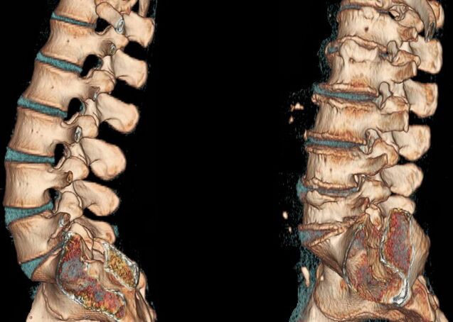 Osteochondrose der Wirbelsäule auf einem CT-Scan