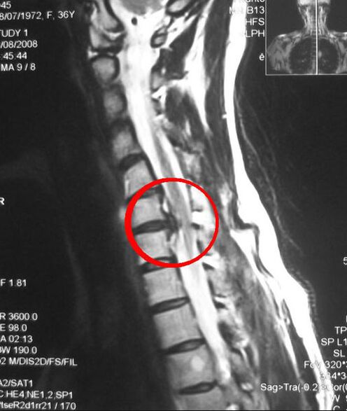 Symptome einer thorakalen Osteochondrose im Röntgenbild. 
